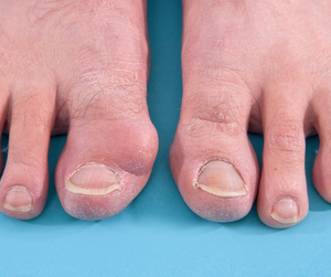 Bunion corrector: Do They Work?