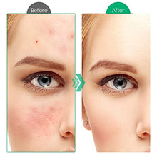 Load image into Gallery viewer, Acne Treatment, GIMGO Acne Scar Removal Serum, Spot Treatment, Cystic Acne Serum for Reduction in Spots,Pimple,Pore Minimizer, Acne Treatment Serum for All Skin of Teen&Women&Men,30ml+30ml (2oz)