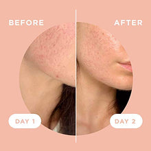 Load image into Gallery viewer, ZitSticka Killa Kit | Self-Dissolving Microdart Acne Pimple Patch for Zits and Blemishes, Spot Treatment Stickers for Face and Skin, Vegan and Cruelty Free (8 Pack)