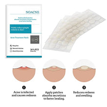 Load image into Gallery viewer, Acne Pimple Patches Acne Spot Treatments Hydrocolloid Patches Invisible Spot & Blemish Acne Stickers 144 Patches