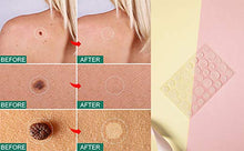 Load image into Gallery viewer, Acne Pimple Master Patches Spot & Blemish Treatment Stickers Invisible Hydrocolloid Patches (216P)