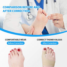 Load image into Gallery viewer, Adepoy Bunion Corrector,Orthopedic Bunion Correctors,Big Toe Separator Pain Relief,for Overlapping Toes,Hallux Valgus Correction,Hammer Toe Straightener,Day Night Support
