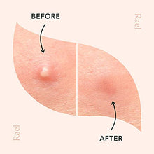 Load image into Gallery viewer, Rael Acne Pimple Healing Patch - Absorbing Cover, Invisible, Blemish Spot, Hydrocolloid, Skin Treatment, Facial Stickers, Two Sizes, Blends in with skin (96 Patches)