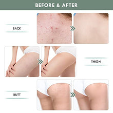Load image into Gallery viewer, Butt Acne Clearing Treatment Cream Thigh Acne Treatment Cream Pure Natural Plant ingredients Clears Acne and Pimples For Bum Cream Keep Buttocks Skin Smooth with Salicylic Acid