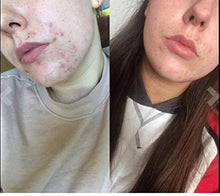 Load image into Gallery viewer, SKINKISSEDโข ๐ช๐๐ก๐ก๐๐ฅ ๐ฎ๐ฌ๐ฎ๐ฌ* Vitamin C and Hyaluronic Acid Serum Helps Remove Acne Scars, Wrinkles, Blemishes & Signs Of Ageing - Natural Skin & Facial Product For Women & Men