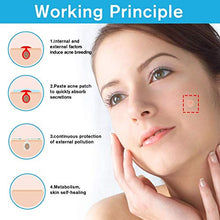 Load image into Gallery viewer, Acne Pimple Master Patches Spot & Blemish Treatment Stickers Invisible Hydrocolloid Patches (216P)