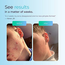 Load image into Gallery viewer, LUSTRE ClearSkin TRIO - Blue Light Acne Treatment Device, UV-Free & Wireless | LED Therapy for Face and Body Acne, Spots and Blemishes | Prevent breakouts, inflammation and Skin Redness | No Chemicals