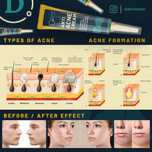 Load image into Gallery viewer, POWERFUL Anti Acne Removal Cream by DermaHour. Formula for Pimples, Spot, Skin Tag, and Ingrown Hair. Balance Water And Oil. Skincare Moisturiser. Ginkgo Biloba Extract. (40ml)
