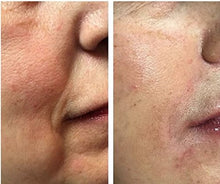 Load image into Gallery viewer, SKINKISSEDโข ๐ช๐๐ก๐ก๐๐ฅ ๐ฎ๐ฌ๐ฎ๐ฌ* Vitamin C and Hyaluronic Acid Serum Helps Remove Acne Scars, Wrinkles, Blemishes & Signs Of Ageing - Natural Skin & Facial Product For Women & Men