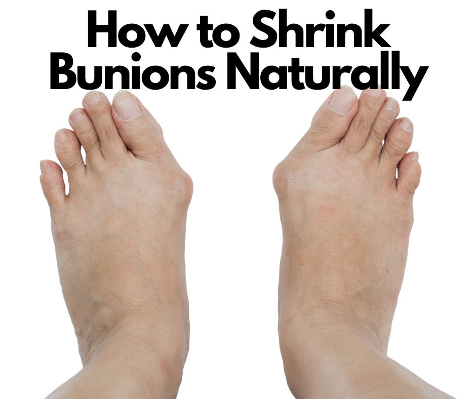 How to Shrink Bunions Naturally: Tips and Tricks