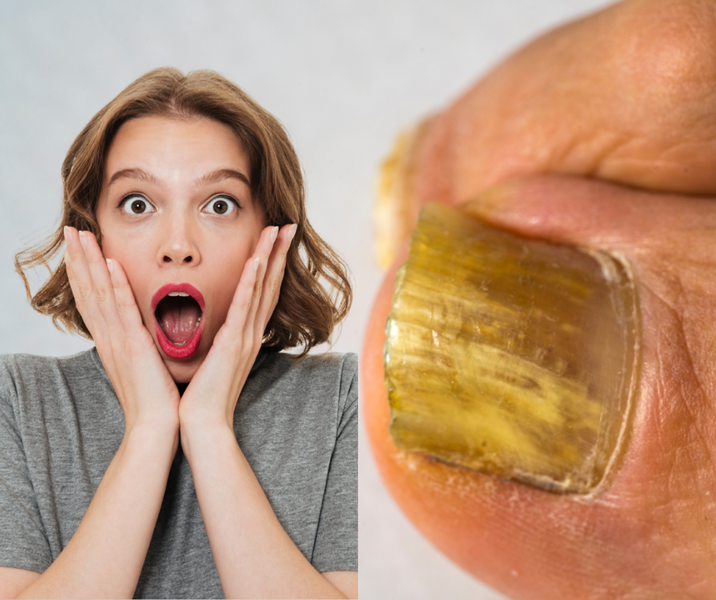 One Cup of This Will Destroy Your Nail Fungus: The Best Natural Solution