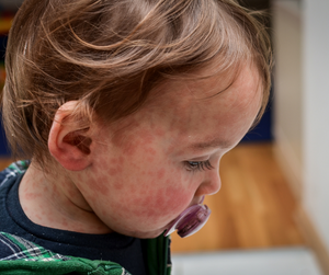 Baby Food Allergy: How to Recognize and React