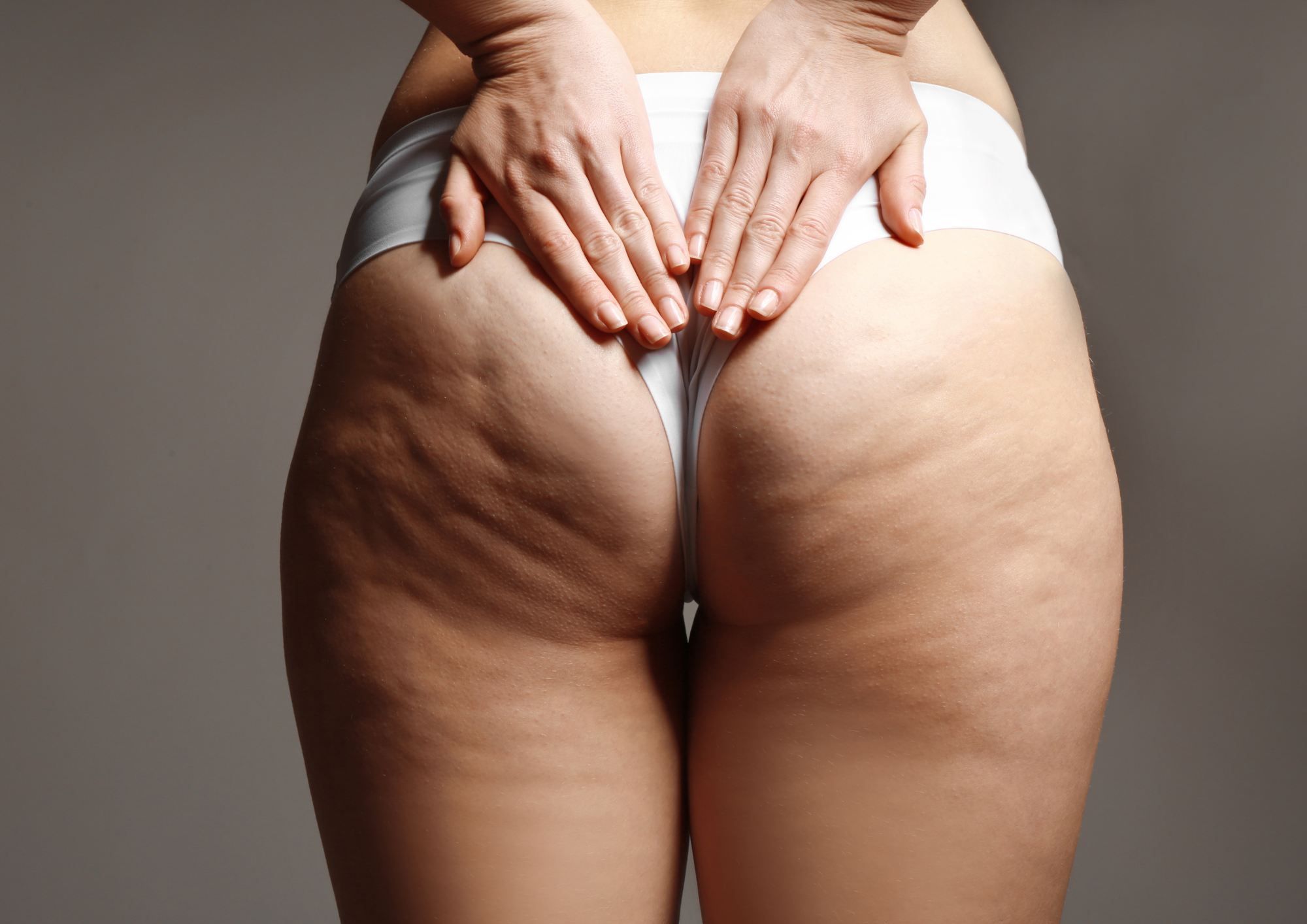 The Best Anti-Cellulite Treatment Options to Help Reduce the Appearance of Cellulite