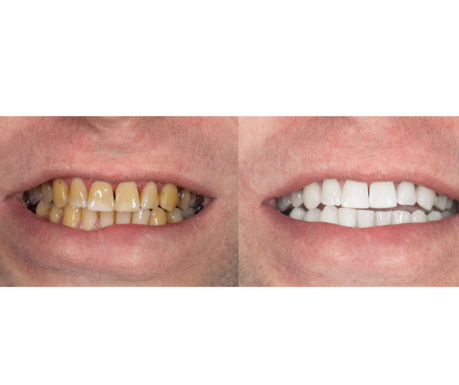 Teeth Whitening London: The Best Options for You