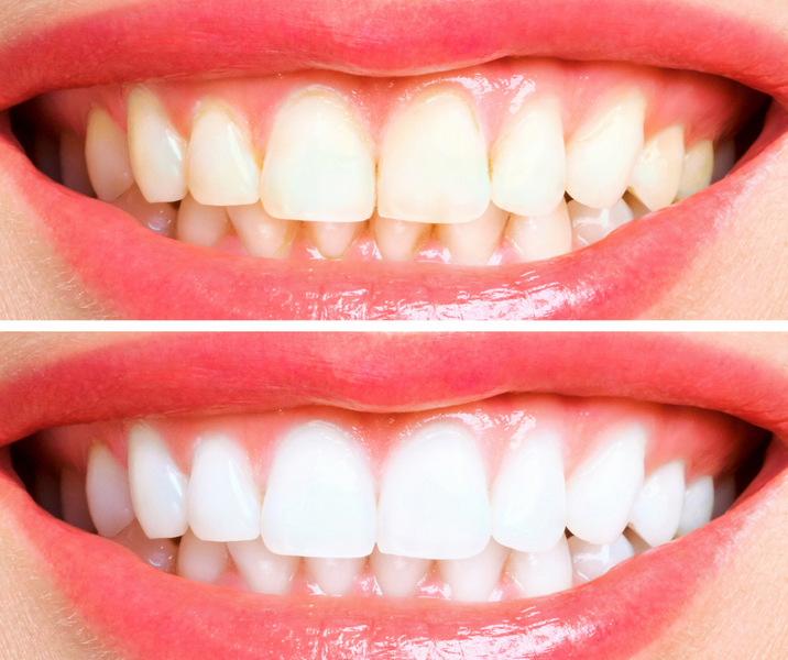 The Best Teeth Whitening Pen Uk: Insider Tips to a Whiter Smile