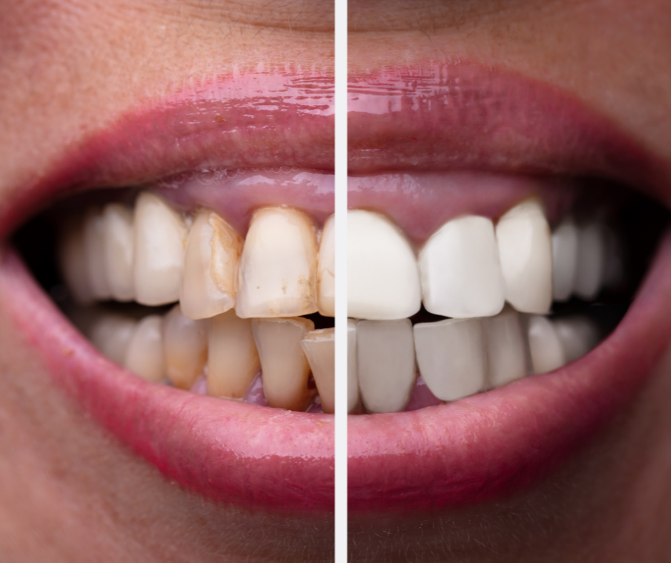 How to Whiten Teeth Overnight in a Safe and Effective Way
