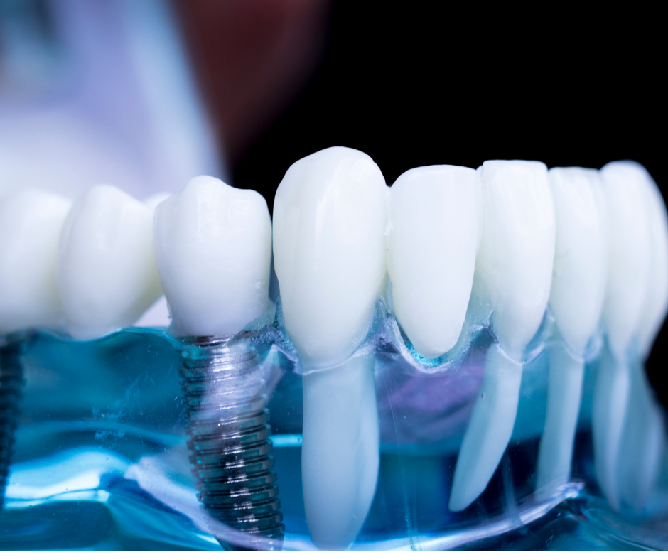 How Much Do Teeth Implants Cost in the UK?