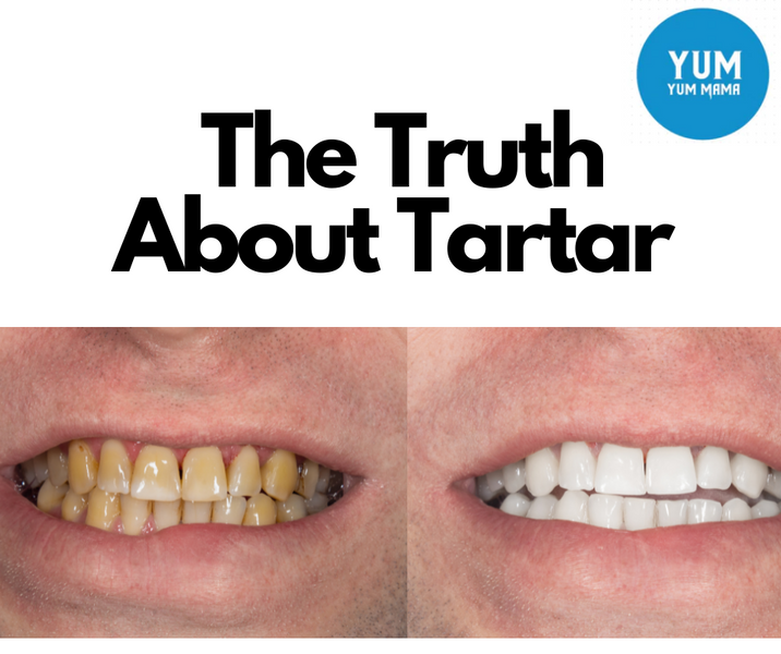 Tartar Removal: Everything You Need to Know