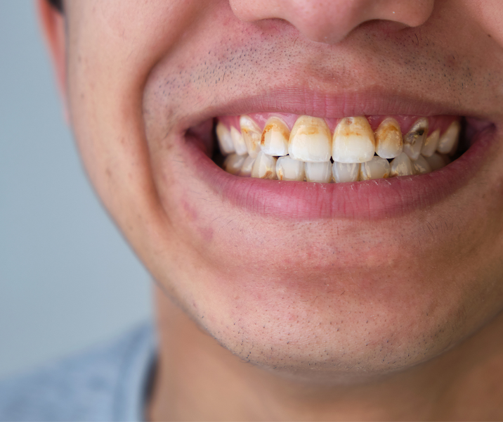 Teeth Tartar: What It Is and How to Remove It