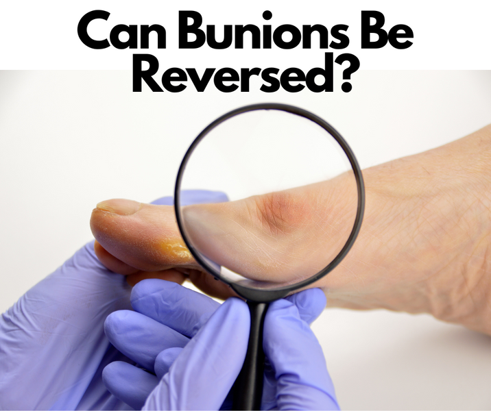 Can Bunions Be Reversed? The Truth About Bunions and How to Treat Them