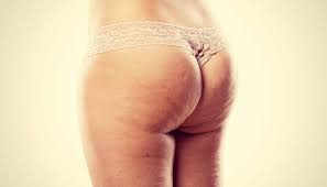 Can cellulite go away?