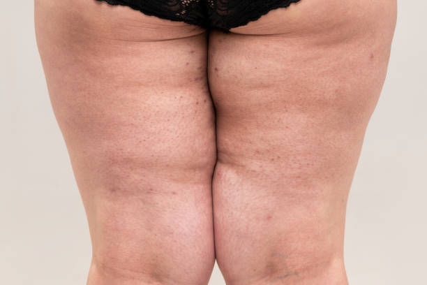 Why You Get Chafing Between Your Thighs.