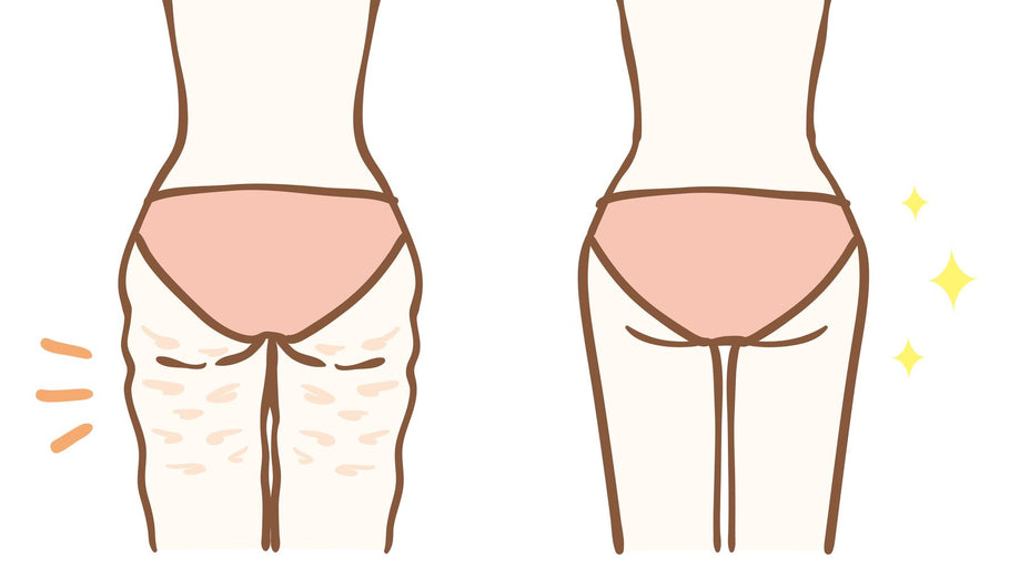 Does cellulite go away?
