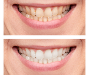 Is Teeth Whitening Permanent?