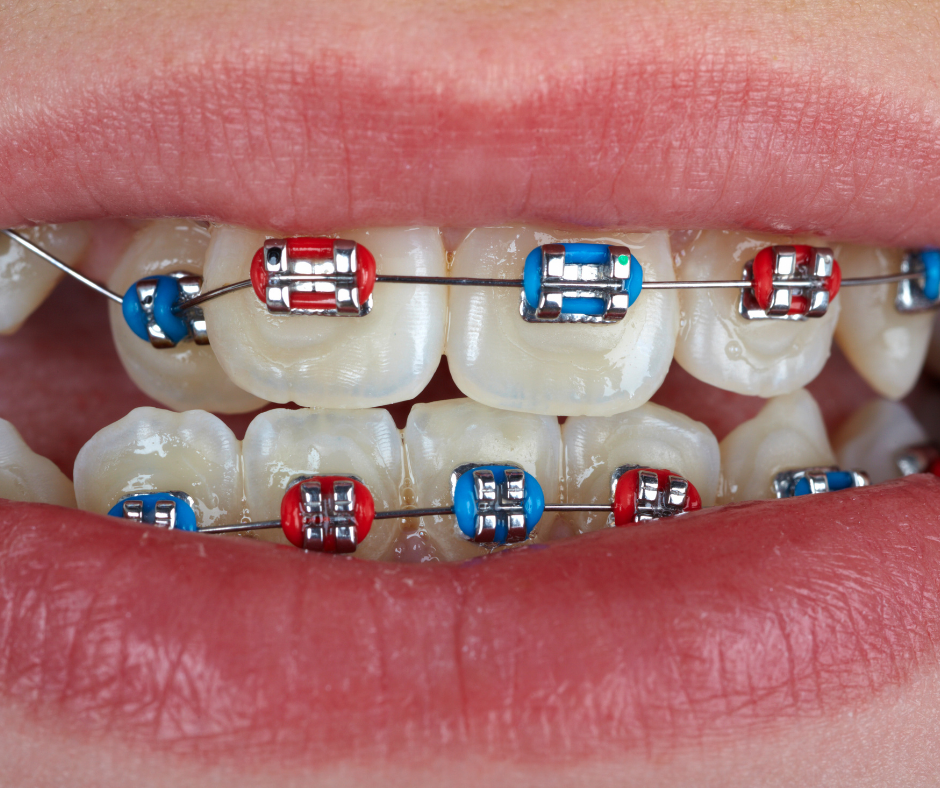 My Teeth Turned Yellow After Braces: What Can I Do?