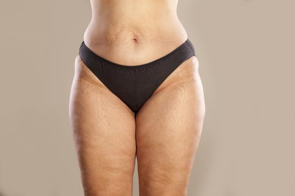 Chafing and Stretch Marks: What You Should Know stretch marks on thighs