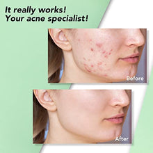 Load image into Gallery viewer, Pimple Patches, Spot Patches, NOACNE Hydrocolloid Patches for Acne Spot Treatment Sticker Anti Blemish Acne Patch 144 Dots
