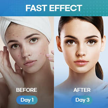 Load image into Gallery viewer, MEEYEE Large Acne Pimple Patch, Spot Treatment, Acne Dots, Pimple Stickers, 6 packs -12 Strips
