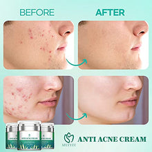 Load image into Gallery viewer, Anti Acne Treatments Cream, Acne Scar Removal Cream, Acne Face Cream, Anti Pimple Cream for Oily Combination or Sensitive Skin of All Ages for All Genders
