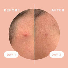 Load image into Gallery viewer, ZitSticka Killa Kit | Self-Dissolving Microdart Acne Pimple Patch for Zits and Blemishes, Spot Treatment Stickers for Face and Skin, Vegan and Cruelty Free (8 Pack)
