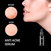 Load image into Gallery viewer, IMIM Acne Treatments Serum Double Strength Spot Blemishes Blackheads Removal Treatment Suitable for Prone to Acne Face Serum for All Skin Types
