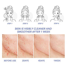 Load image into Gallery viewer, Acne Treatment Cream Lopsx Spot Treatment for Spots Blemishes Problem Skin Double Strength Suitable and Safe for Prone to Acne Skin &amp; Sensitive Skin
