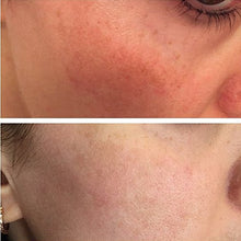Load image into Gallery viewer, SKINKISSED™ 𝗪𝗜𝗡𝗡𝗘𝗥 𝟮𝟬𝟮𝟬* Vitamin C and Hyaluronic Acid Serum Helps Remove Acne Scars, Wrinkles, Blemishes &amp; Signs Of Ageing - Natural Skin &amp; Facial Product For Women &amp; Men
